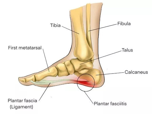 Can Plantar Fasciitis Be Cured? | Plantar Fasciitis Heel Pain